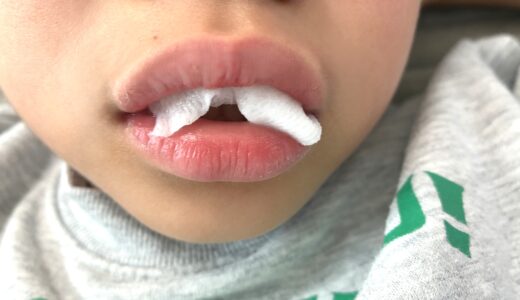 小2息子・上唇小帯を切除した話